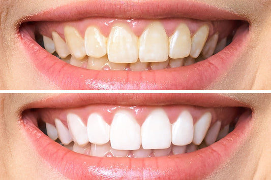 The Ultimate Guide to Teeth Whitening: Techniques, Benefits, and Best Practices